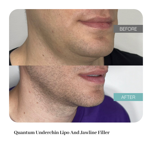 Before and after result